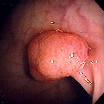 Colonoscopy image showing a smooth polyp projecting from the colonic mucosa.