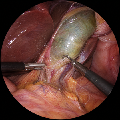 Representative laparoscopic surgery video frame.