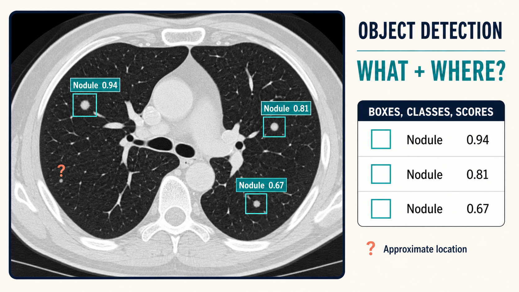 An axial lung CT contains three pulmonary nodules enclosed by separate rectangular boxes with confidence scores. A small unboxed candidate illustrates a possible missed detection.