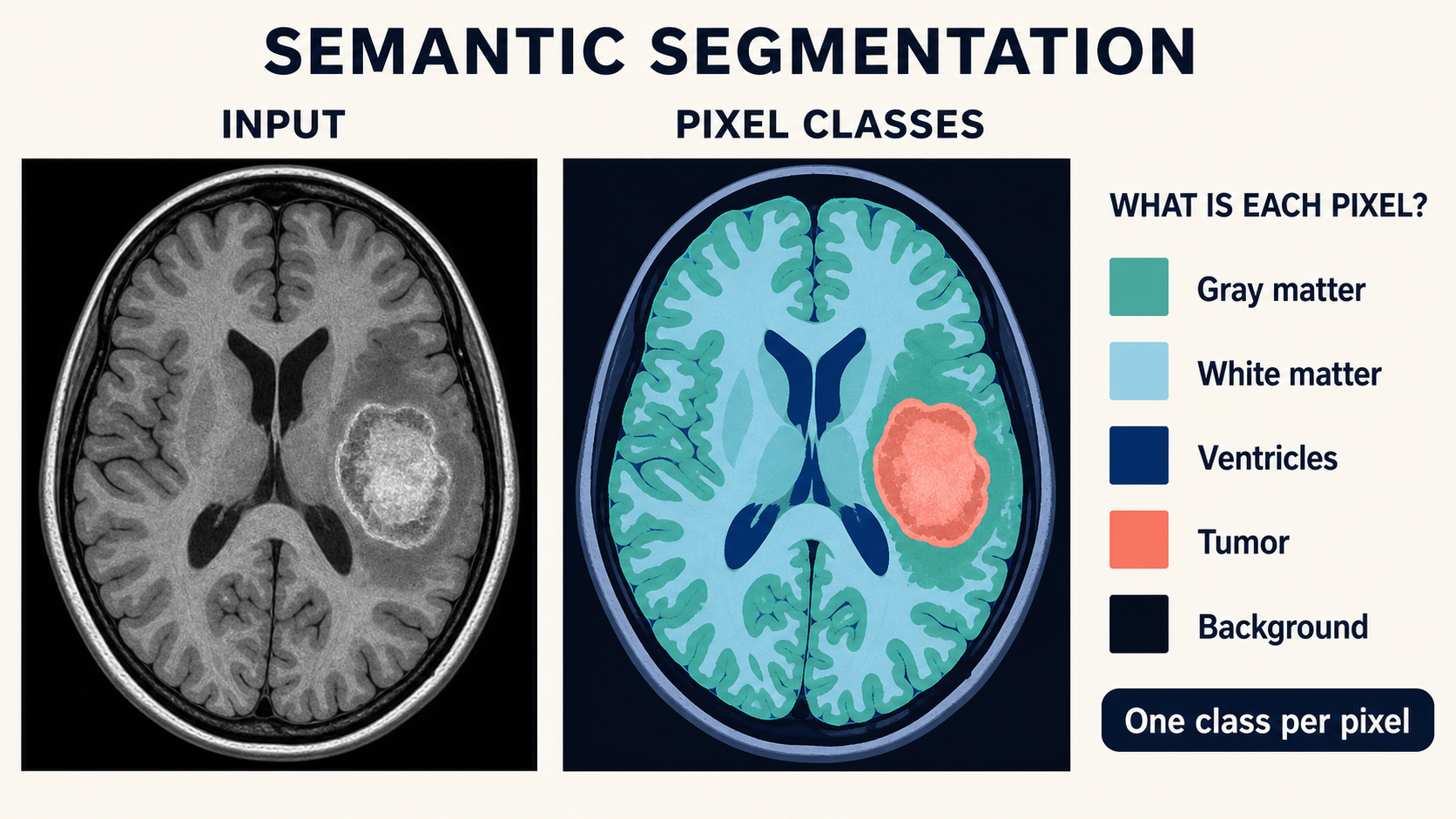 A grayscale axial brain MRI is shown beside the same slice with colored masks assigning each pixel to gray matter, white matter, ventricles, tumor, or background.