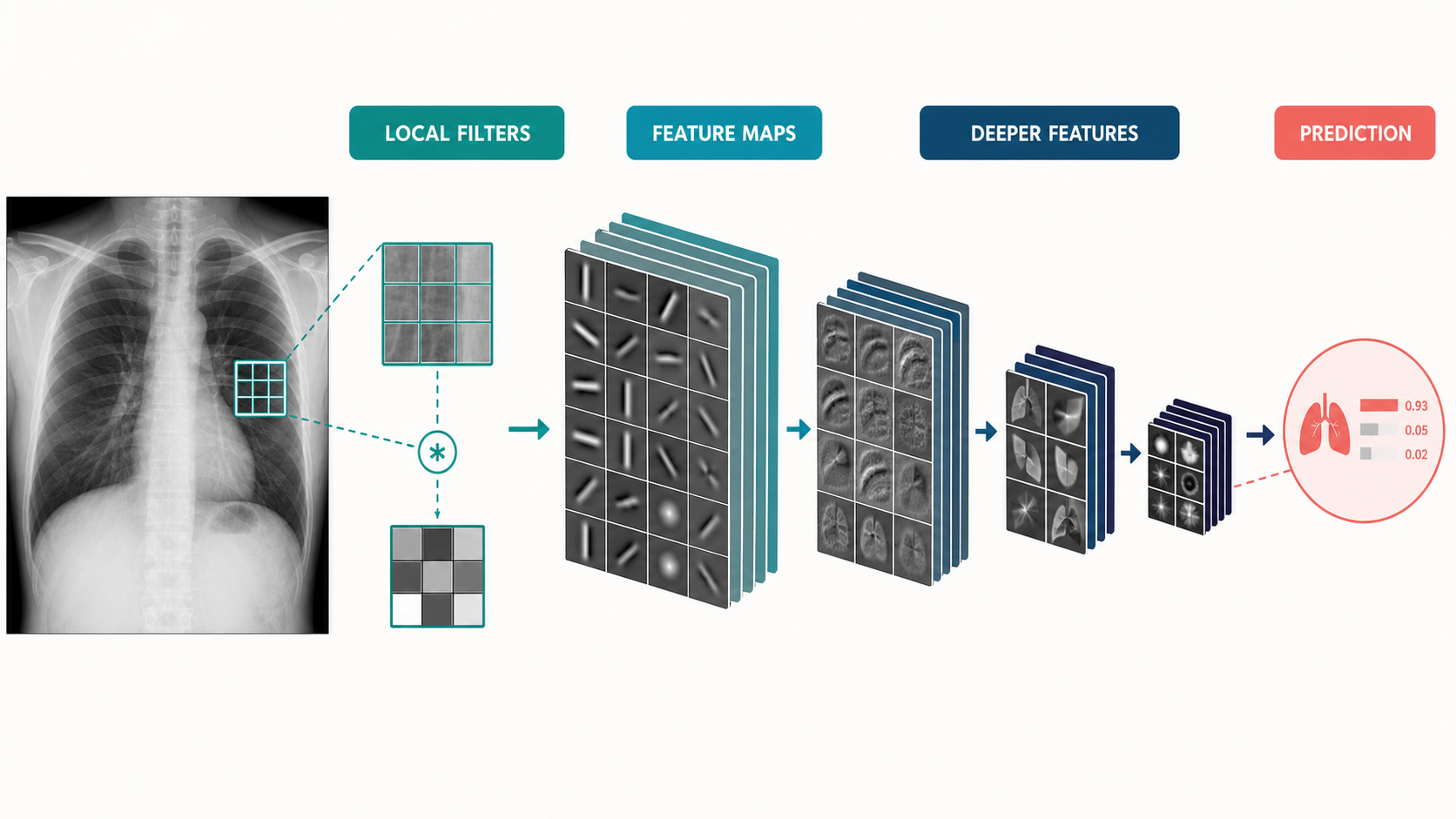 A chest radiograph passes through a highlighted local filter, stacks of progressively smaller feature maps, deeper feature representations, and a final prediction.