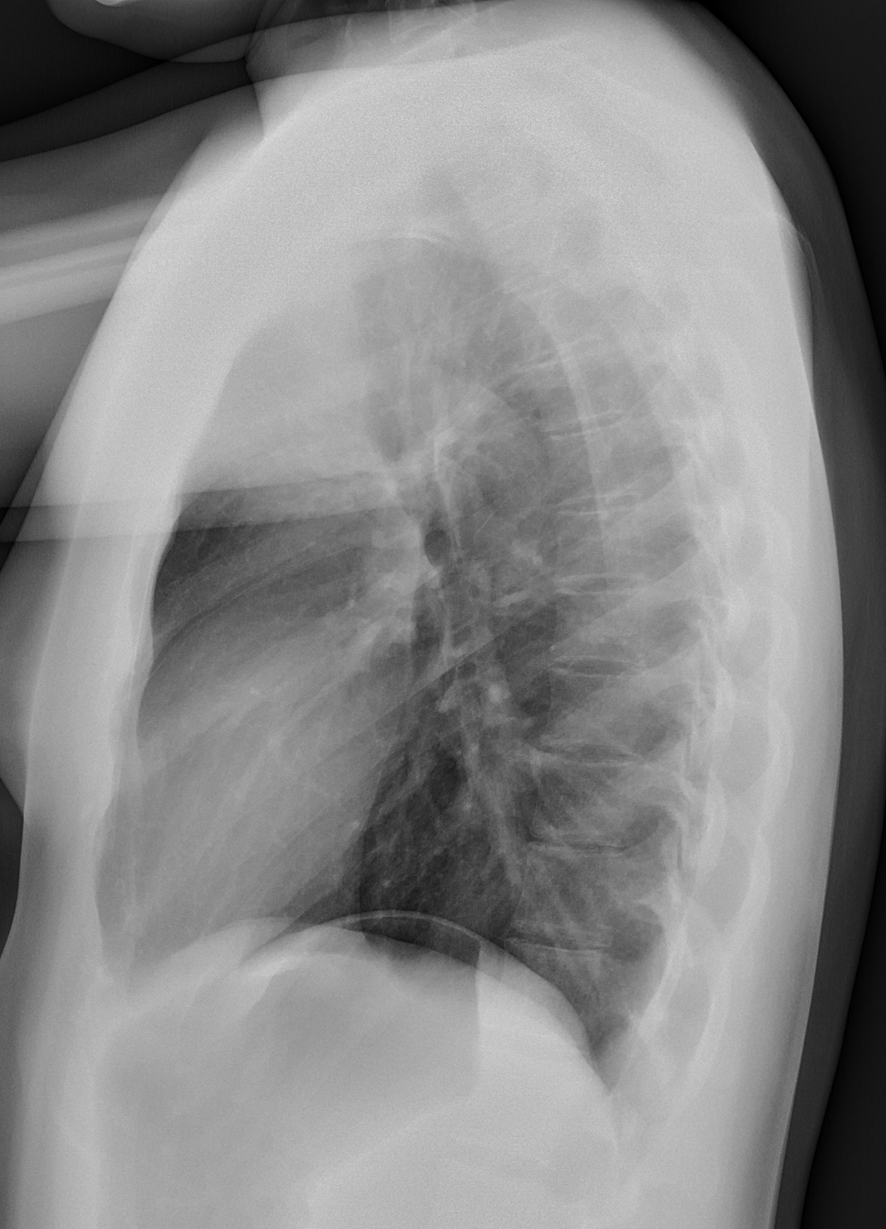 Lateral chest radiograph showing overlapping ribs, the spine and the anterior cardiac silhouette.