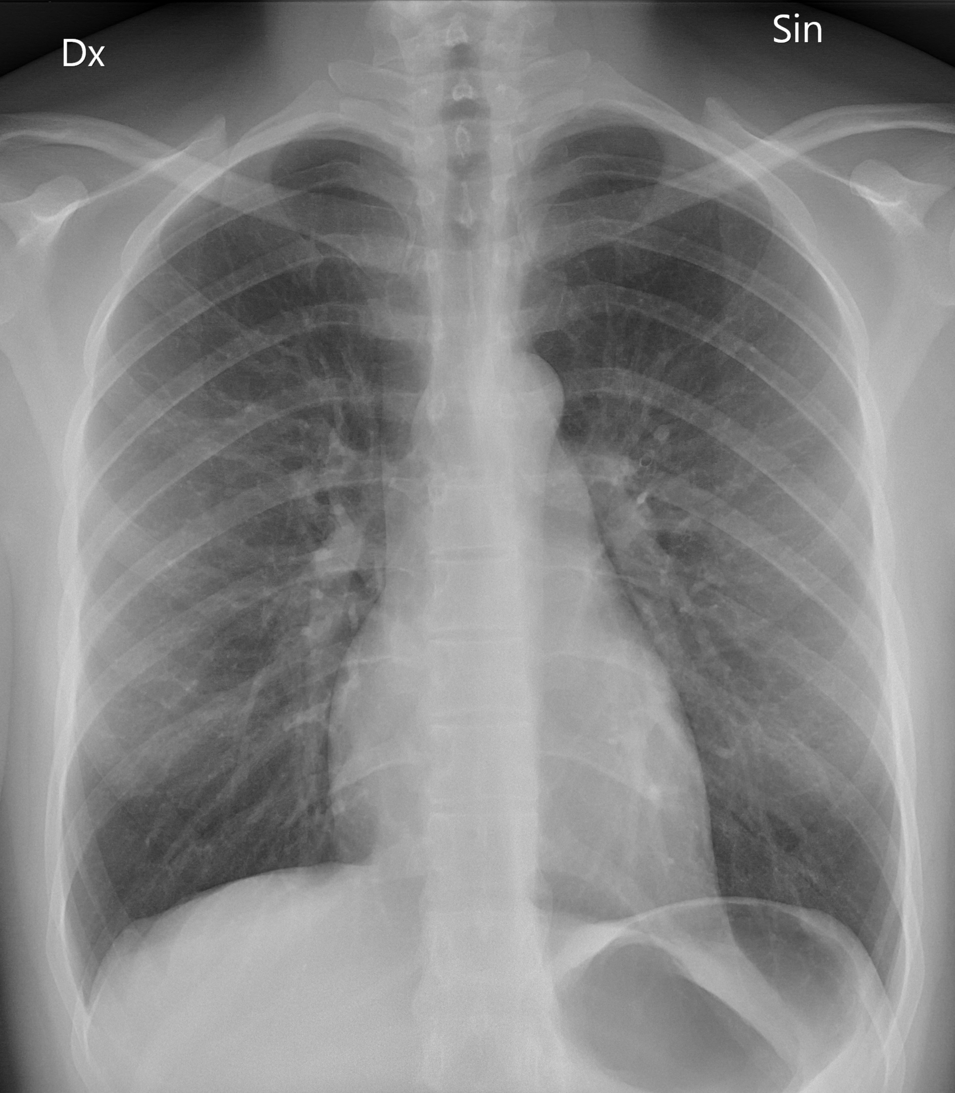 Frontal PA radiograph showing lungs, ribs, cardiac silhouette and diaphragms without added AI markings.